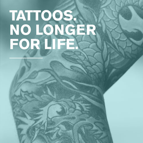Laser tattoo removal | Auckland Dermatology